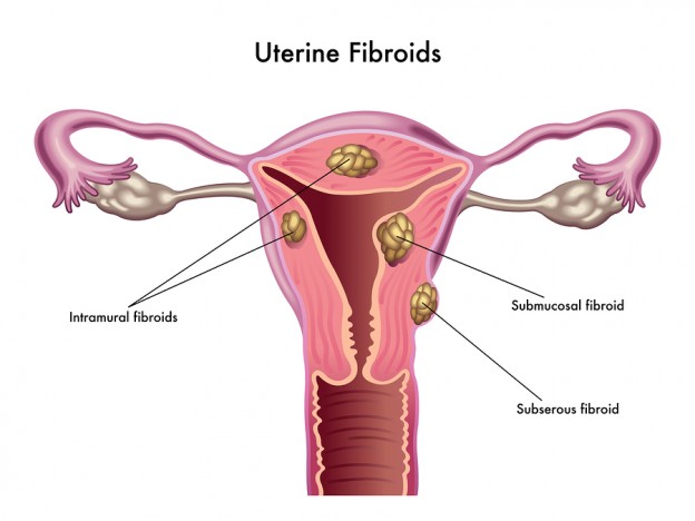 What’s New with Fibroids?