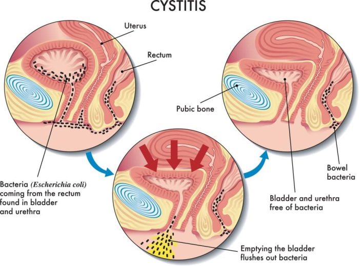 What Does Recurring Bladder Infections Mean