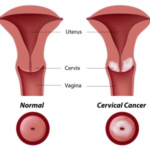 cervical dysplasia cancer abnormal PAP smear