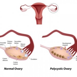 functional ovarian cyst vs pathological cyst